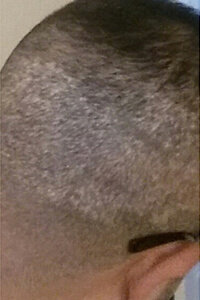 Hair Transplant Fue Scar 