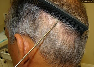 Dr. Brett Bolton Hair Transplant  Suture lines