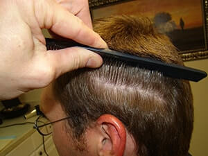 Dr. Brett Bolton Hair Transplant  Suture lines