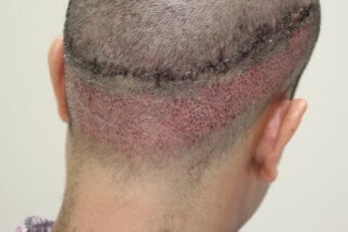 Hair Transplant Fue Scar 