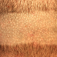 Hair Transplant Fue Scar Maxharvest Correction