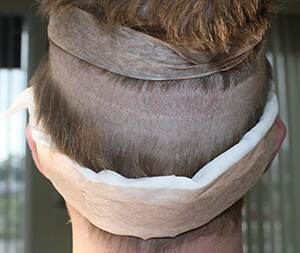 Dr. Brett Bolton Hair Transplant  Suture lines