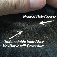 Hair Transplant Fue Scar