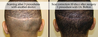 Dr. Brett Bolton Hair Transplant  Suture lines