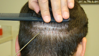 Dr. Brett Bolton Hair Transplant  Suture lines