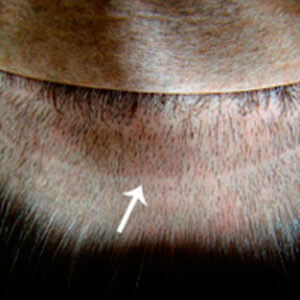 Dr. Brett Bolton Hair Transplant  Suture lines