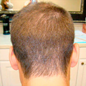 Dr. Brett Bolton Hair Transplant  Suture lines