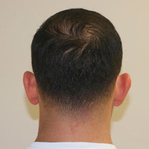 Dr. Brett Bolton Hair Transplant  Suture lines