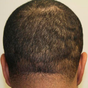 Dr. Brett Bolton Hair Transplant  Suture lines