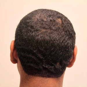 Dr. Brett Bolton Hair Transplant  Suture lines