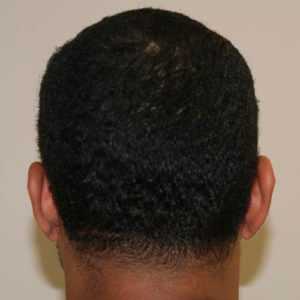 Dr. Brett Bolton Hair Transplant  Suture lines