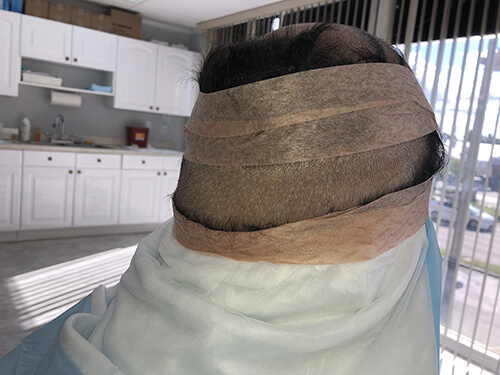 Hair Transplant Fue Scar 