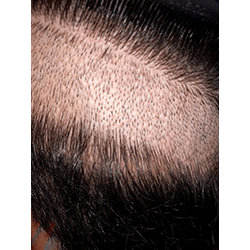 Hair Transplant Fue Scar 