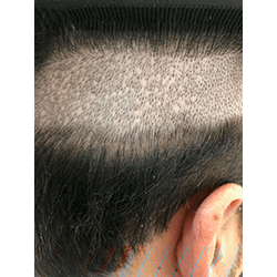 Hair Transplant Fue Scar 