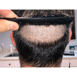 Hair Transplant Fue Scar 