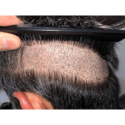 Hair Transplant Fue Scar 