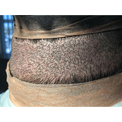 Hair Transplant Fue Scar 