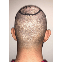 Hair Transplant Fue Scar 