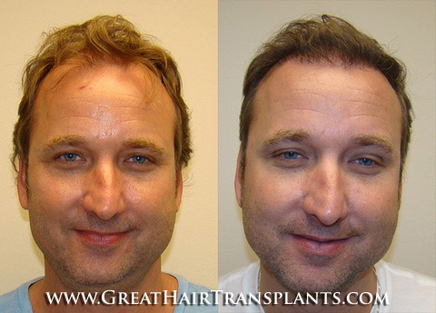 hair transplant surgery