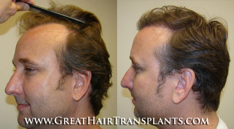 low cost hair transplant