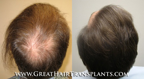 hair transplantation