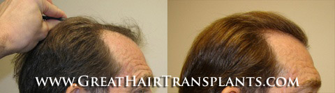 hair replacement
