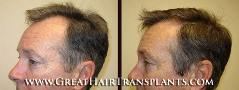 hair transplant cost