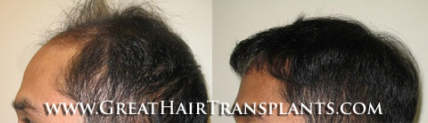 low cost hair transplant
