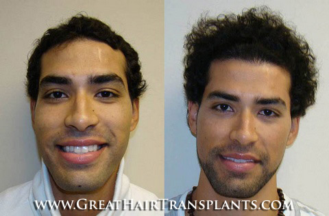 how much does a hair transplant cost
