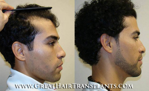 hair transplants