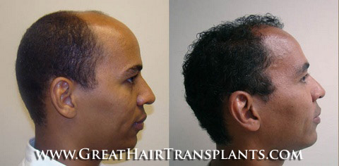 hair loss