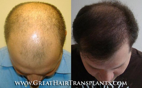 hair restoration