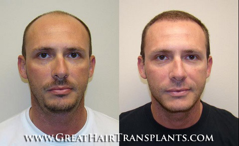 hair transplants