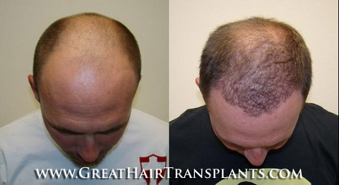 hair loss prevention