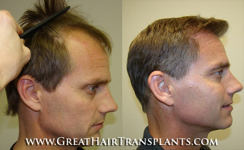 hair transplants