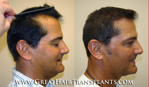 hair loss treatment