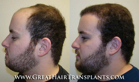hair implant