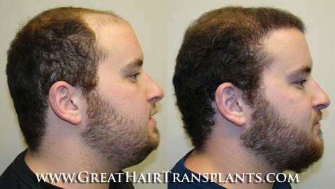 low cost hair transplant