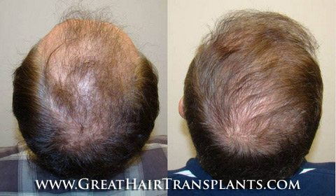 hair replacement