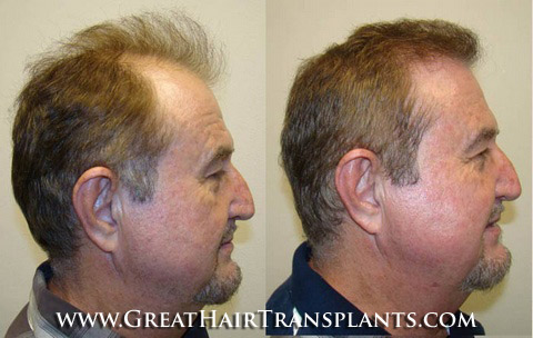 low cost hair transplant