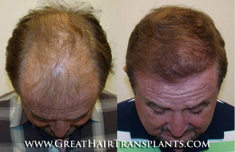 hair restoration