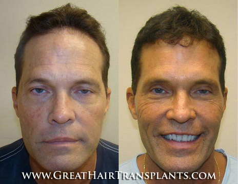 hair loss