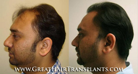 hair transplant