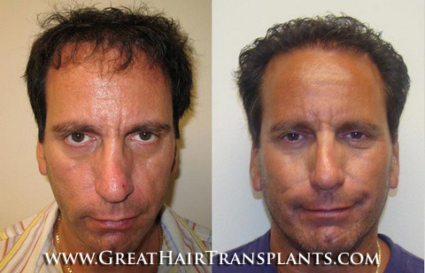 hair transplant