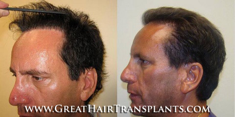 hair transplant