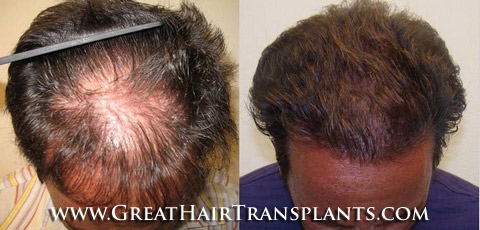 hair transplant surgery