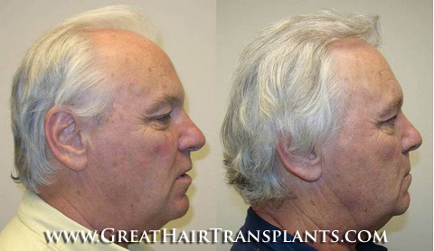 low cost hair transplant