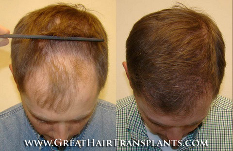 hair system
