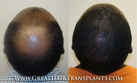 hair procedures