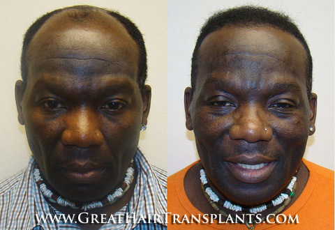 hair transplant surgery